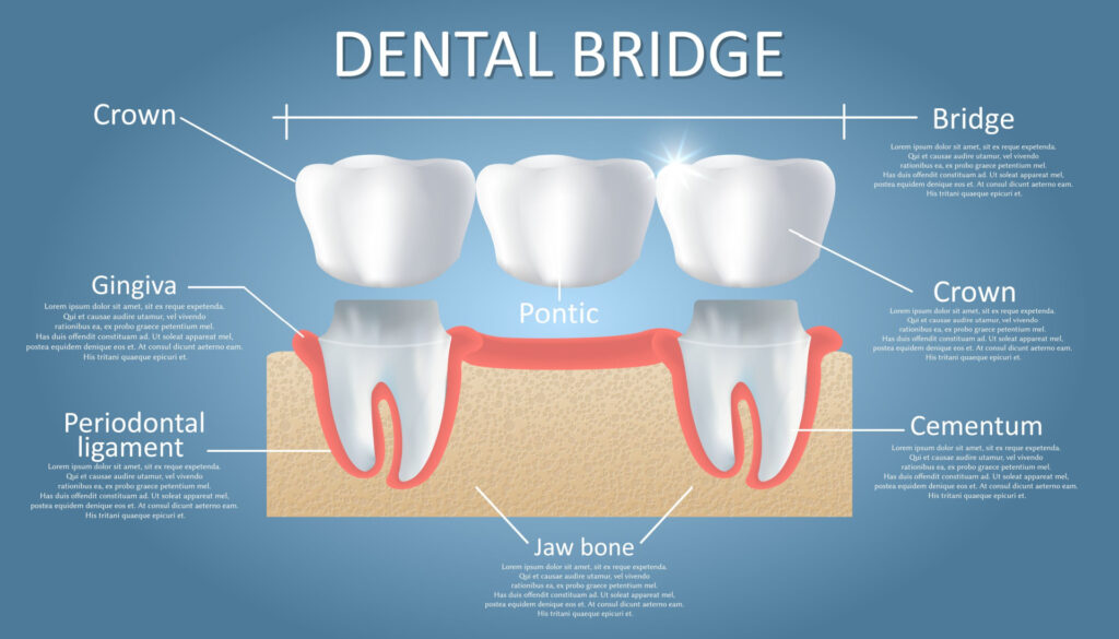 Example illustration for Dental Bridges