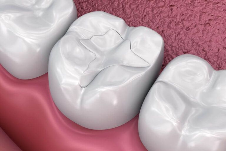 Dental fissure fillings, Medically accurate 3D illustration